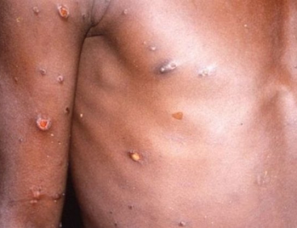 Waspada Pseudo-pustula, Gejala Cacar Monyet yang Baru Diidentifikasi